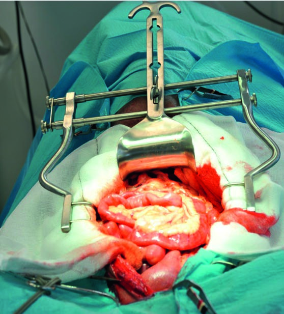 Gastro-intestinal Surgery